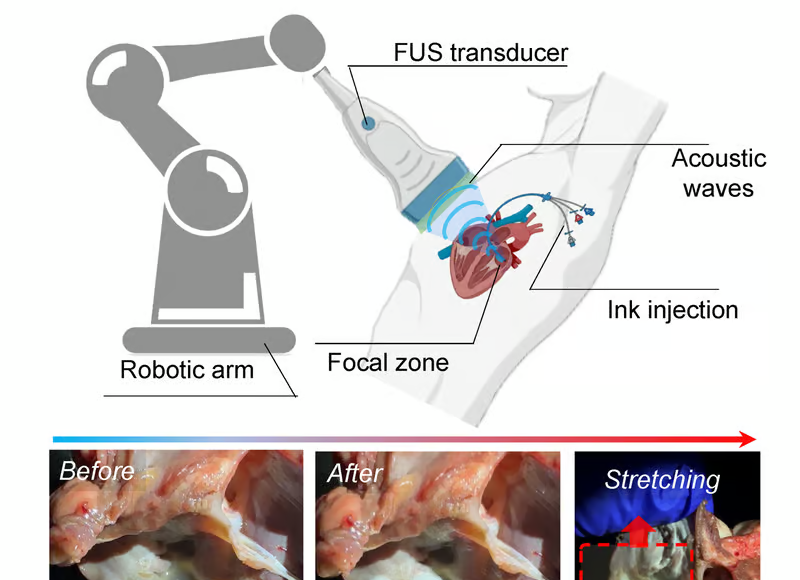 Ilustración del uso de tecnología de impresión 3D asistida por ultrasonidos. En la parte superior, un esquema muestra un brazo robótico con un transductor de ultrasonido (FUS) dirigido hacia el corazón, emitiendo ondas acústicas hacia una zona focal mientras se realiza la inyección de tinta biocompatible en el tejido. En la parte inferior, tres imágenes reales muestran los resultados de la técnica: (1) un tejido dañado antes de la intervención, (2) el tejido reparado tras la solidificación de la tinta, y (3) una prueba de estiramiento del implante para evaluar su resistencia.