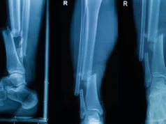 Cirujanos ahora pueden «imprimir» huesos directamente en el quirófano con una pistola de pegamento modificada Radiografías médicas de una pierna derecha en tres vistas diferentes, mostrando una fractura grave en los huesos de la tibia y el peroné cerca del tobillo.